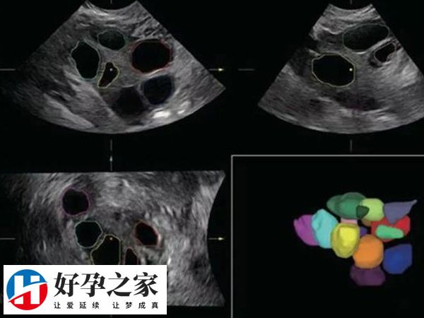 多囊不排卵卵子去哪了