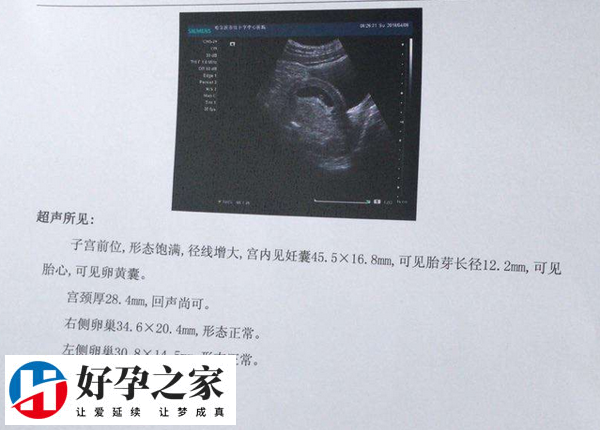 二维b超是最基本的超声成像技术