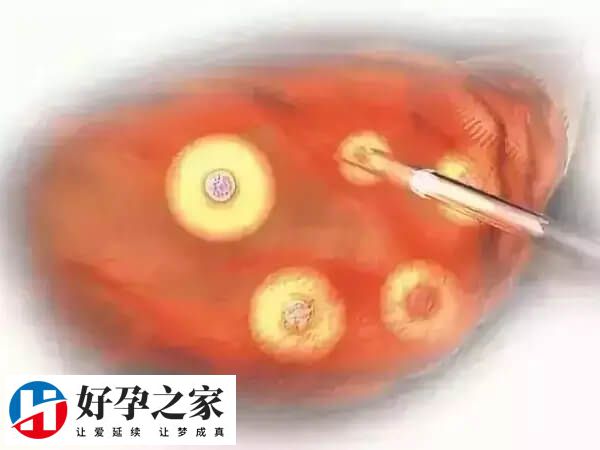 取卵是在超声下穿刺抽吸卵泡的一种手术