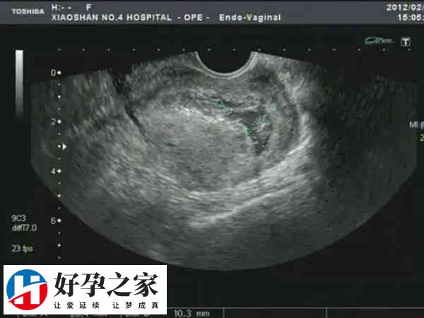 疤痕子宫不建议怀双胞胎