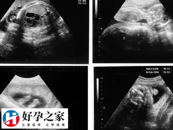 着床后就会开始有孕囊