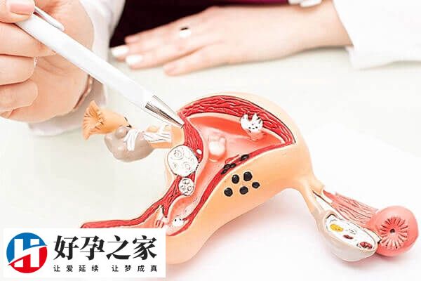 子宫受损是导致子宫腺肌症的原因之一