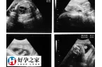 试管婴儿移植第38天孕囊应该多大