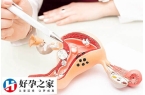 子宫腺肌症的原因是什么
